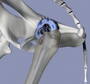 hip-replacement-2
